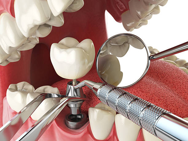 Best Emergency Wisdom Teeth Removal in Lakeway, TX